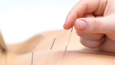 Dryneedling